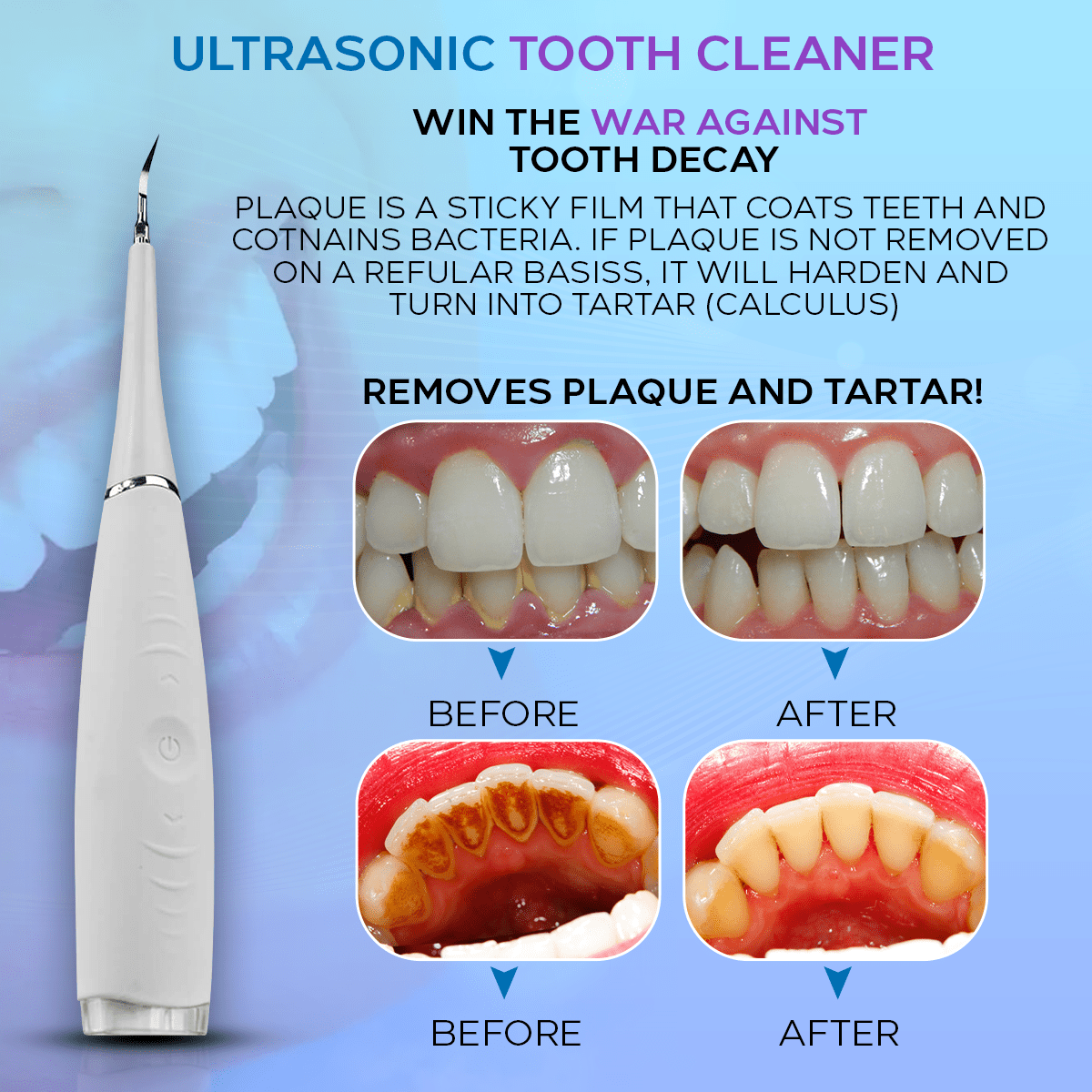 Ultrasonic Tooth Cleaner - Remove Tartar At Home